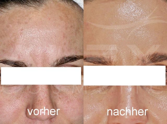 Vorher-Nachher Bild 1 herbs2peel Vorher-Nachher Bild 1