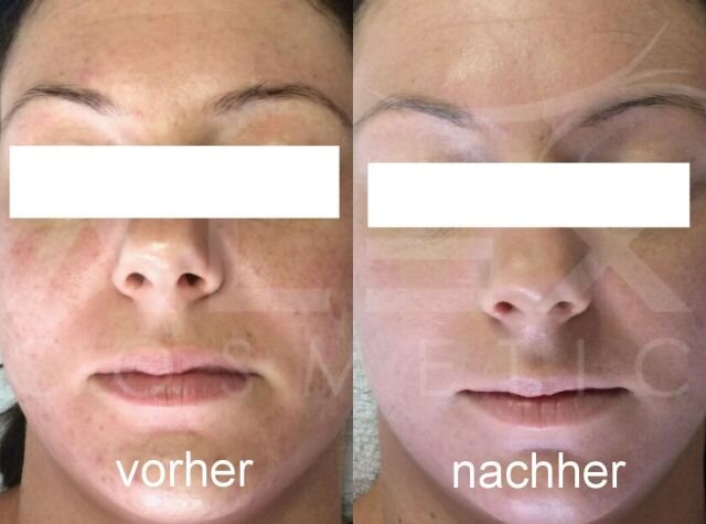 Vorher-Nachher Bild 2 herbs2peel Vorher-Nachher Bild 2