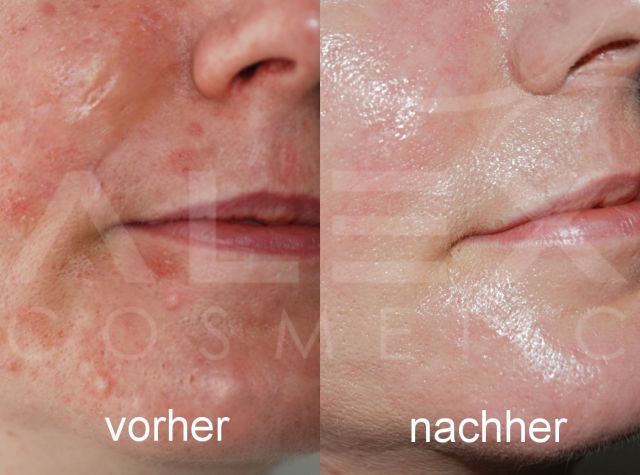 Vorher-Nachher Bild 1 herbs2peel Vorher-Nachher Bild 1
