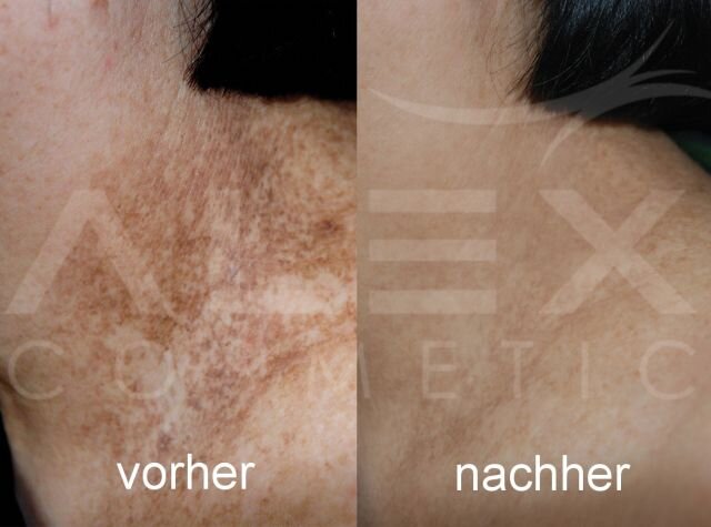 Vorher-Nachher Bild 2 herbs2peel Vorher-Nachher Bild 2