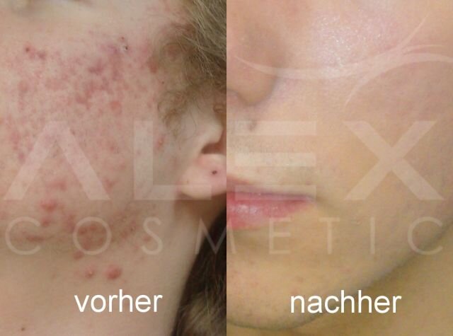 Vorher-Nachher Bild 3 herbs2peel Vorher-Nachher Bild 3
