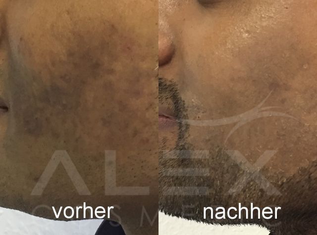 Vorher-Nachher Bild 4 herbs2peel Vorher-Nachher Bild 4