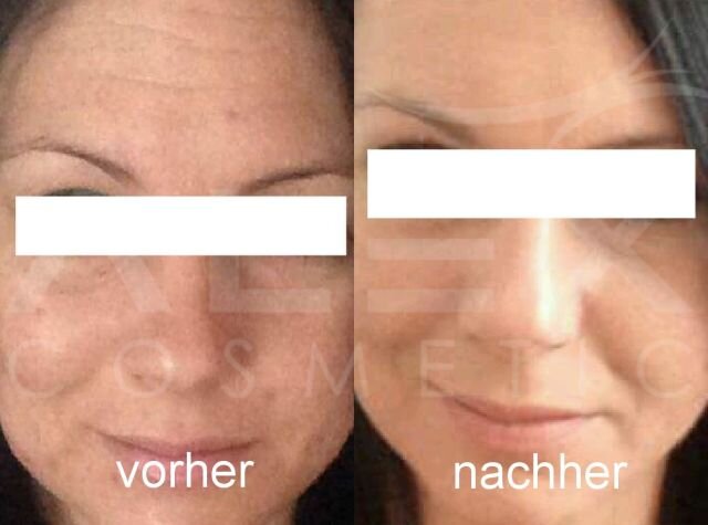Vorher-Nachher Bild 5 herbs2peel Vorher-Nachher Bild 5