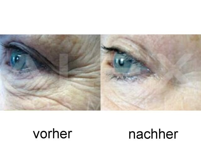 Vorher-Nachher Bild 6 herbs2peel Vorher-Nachher Bild 6
